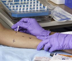 Skin_prick_testing_for_allergies