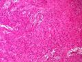 Ovarian tumor
