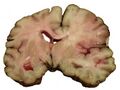 MCA Stroke Brain Human