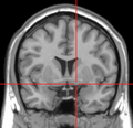 Substantia innominata MRI