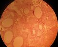 Adenomatoid odontogenic tumor