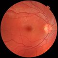 Fundus photograph of normal right eye