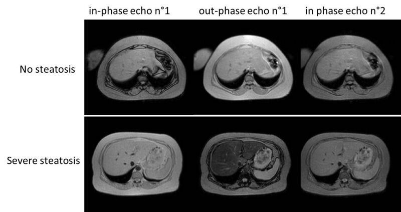 MRI Liversteatosis