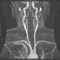 Deep brain stimulation
