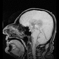 MRI of normal pressure hydrocephalus
