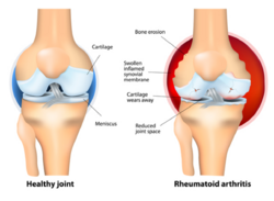 Rheumatoid-Arthritis