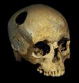 Trepanated Skull of a Woman