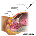 Laparoscopic hiatal hernia repair