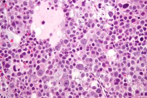 Seminoma Micrograph