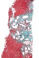 Von Meyenburg complex low magnification