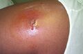 Cutaneous abscess MRSA staphylococcus aureus