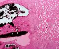 Renal Oncocytoma