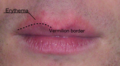 Erythema around the lips