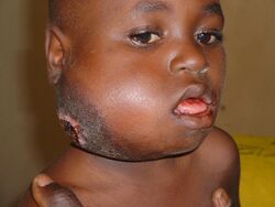 Large facial Burkitt's Lymphoma