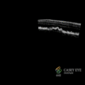 Cyanopsia