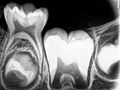 Intraoral Periapical Radiograph (IOPA) showing Deciduous (Milky or Primary) Tooth 75 and developing crown of Permanent or Secondary Teeth 35, 36 and 37