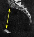Low-dose CT of obstetric conjugate