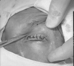 Entropion and trichiasis secondary to trachoma