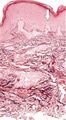 Histopathology of elastosis perforans serpiginosa