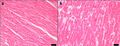 Histopathology of myocardial hypertrophy