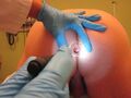 Anoscopic Exam Photo