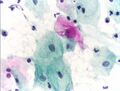Pap test abnormal