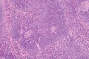 Castleman disease - intermed mag