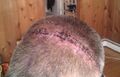 Surgical staples used in a craniotomy