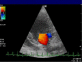 Transthoracic echocardiogram