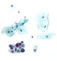 High-grade squamous intraepithelial lesion