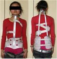 Milwaukee brace - with neck ring and mandible pad