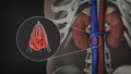 3D Medical Animation of Inferior Vena Filter