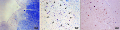 Dorsal motor nucleus of Vagus with Lewy body pathology (alpha synucleinopathy)