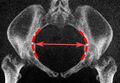Low-dose CT of transverse diameter of pelvic inlet