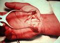 Carpal Tunnel Syndrome, Operation