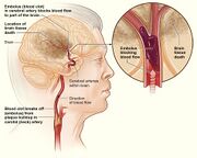 Stroke ischemic