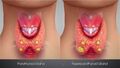 3D animation still of hyperparathyroidism