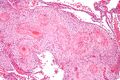 Hypertrophic decidual vasculopathy intermediate magnification