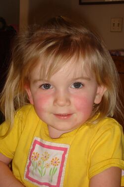 Scarlet fever with slapped cheek and white mustache look