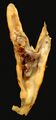 Carotid plaque
