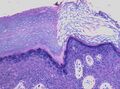 Histopathology of reactive hyperkeratosis
