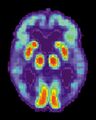 Alzheimer's disease