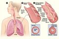 Asthma