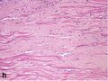 Histopathology of dense fibrous scar replacing myocyte loss in myocardial infarction
