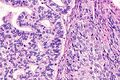 Histopathology of adenosquamous carcinoma of the lung