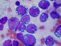 Burkitt lymphoma, touch prep, Wright stain