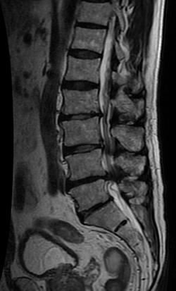Lumbar spinal stenosis