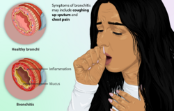 Depiction of a person suffering from Bronchitis