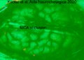 Middle Cerebral Artery occlusion, Kentar et al Acta Neuroch 2020