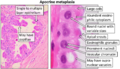 Histopathology of apocrine metaplasia of breast